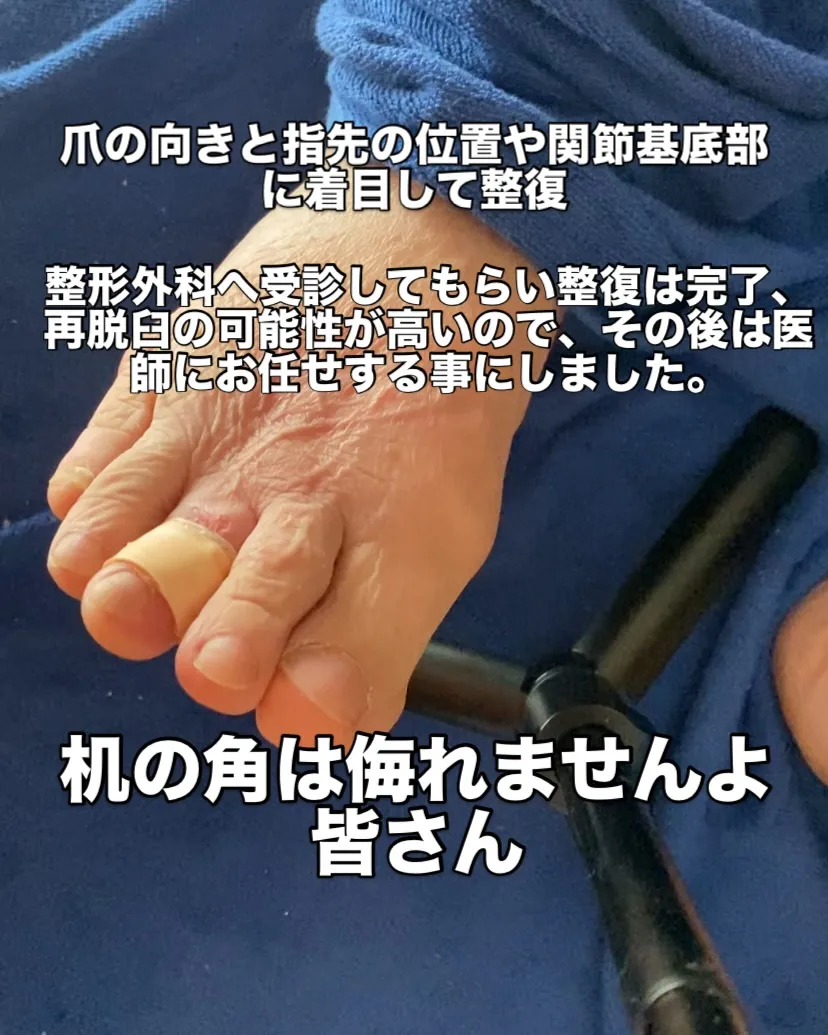 【衝撃‼️】机にぶつけてしまっただけで足の中指脱臼！？