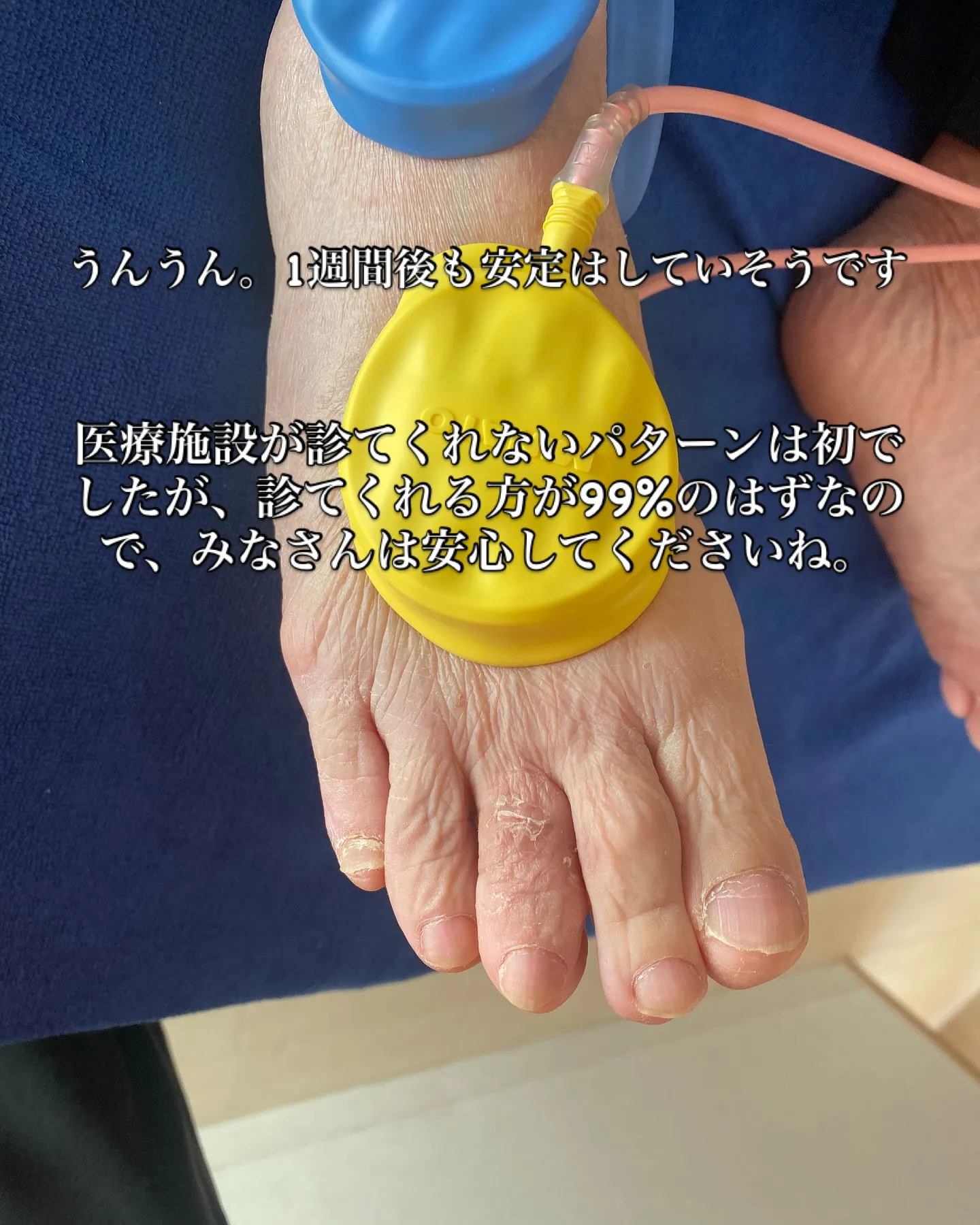 【衝撃‼️】机にぶつけてしまっただけで足の中指脱臼！？